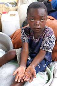 Five-year-old Faleke shows her scabies-afflicted hands. The lack of water is an obstacle to proper hygiene for her and the several hundred other displaced people from North Kivu living in her building. 