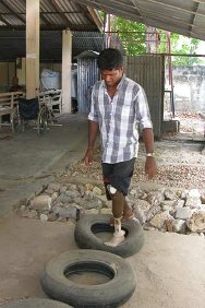 Jaffna Jaipur Centre for Disability and Rehabilitation. This landmine victim is one of hundreds of people assisted by the ICRC through physical rehabilitation and livelihood support projects.