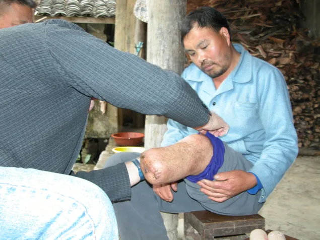 Yunnan. Orthopaedic rehabilitation centre in cooperation with ICRC.