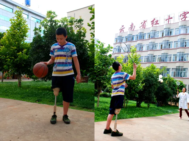 经过康复中心的精心治疗，盘朝杰不但行走自如，而且能跑步运动，篮球、羽毛球也打得很好。