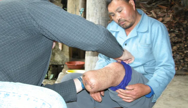 Yunnan. Orthopaedic rehabilitation centre in cooperation with ICRC.