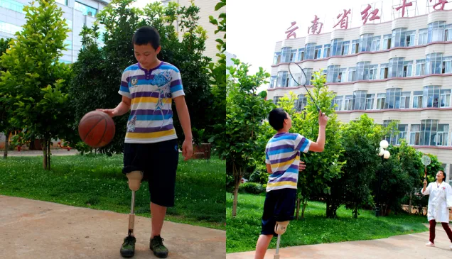 经过康复中心的精心治疗，盘朝杰不但行走自如，而且能跑步运动，篮球、羽毛球也打得很好。