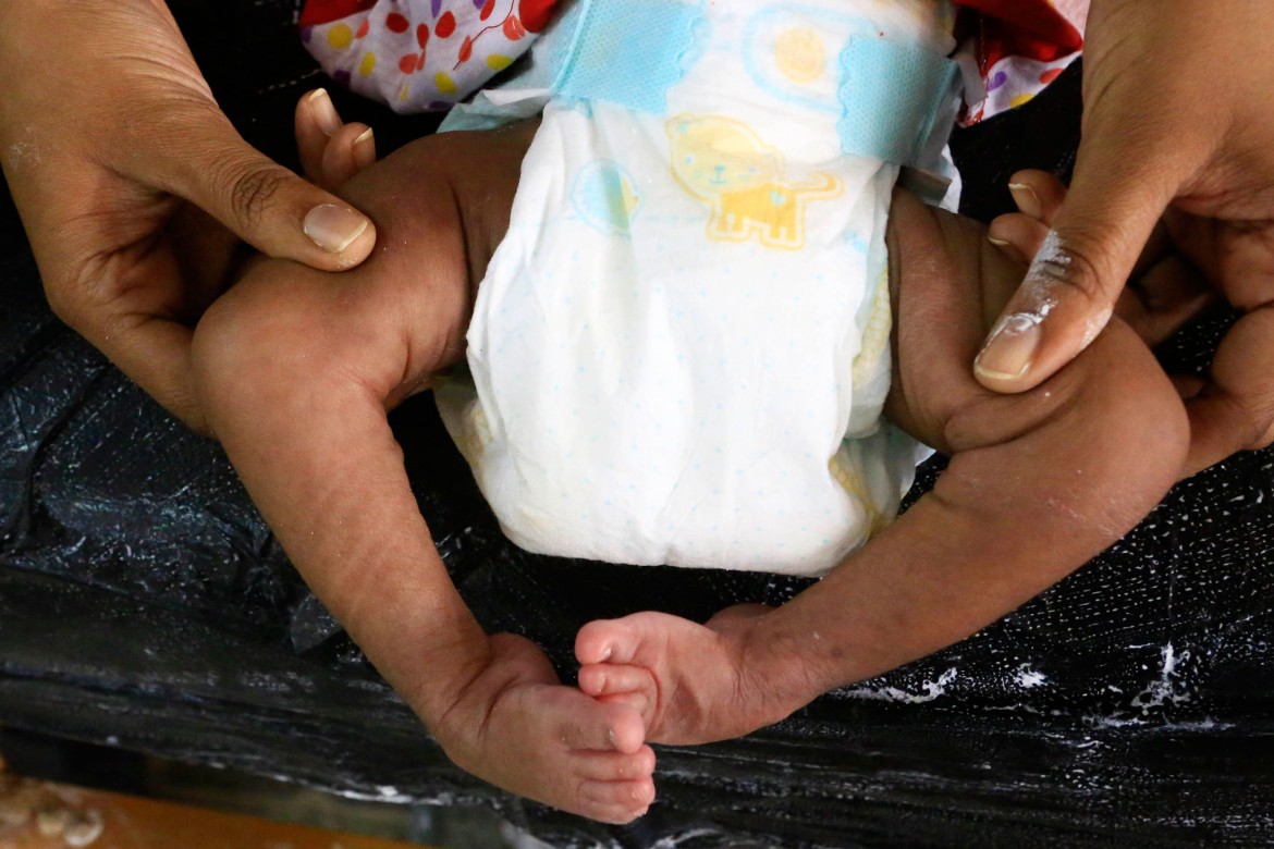 Sudan Treating Children Affected By Clubfoot Icrc